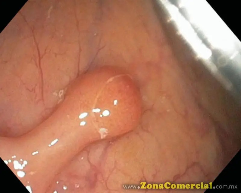 Endoscopia